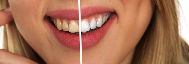 Jak mieć białe zęby? 5 sposobów na piękny uśmiech